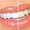 Правда об отбеливании зубов